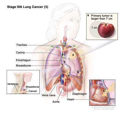 lung-carcinoma-stage3APart3_400_360.jpeg