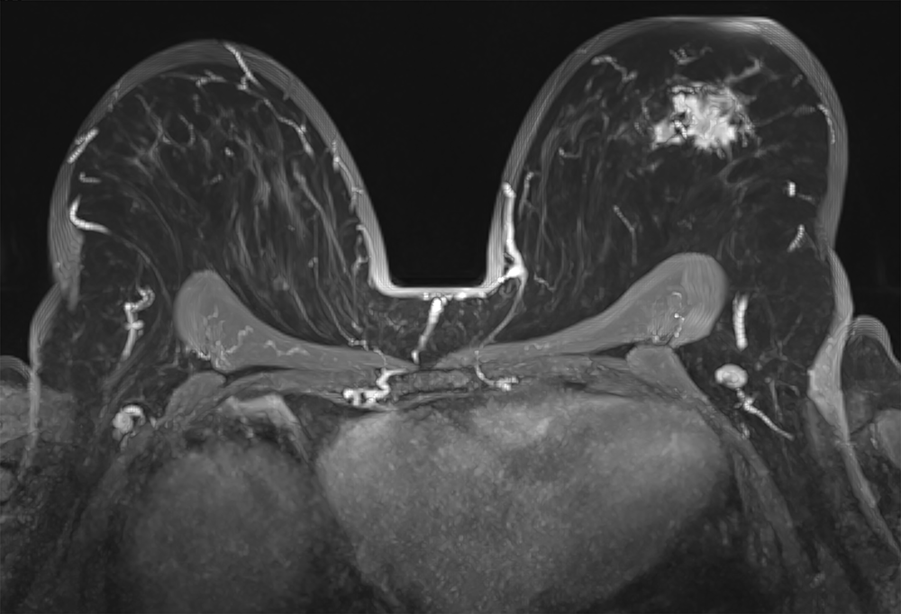 Photo of MRI guided breast biopsy