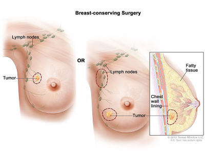 breast-conserving-surgery-female_400_294.jpeg