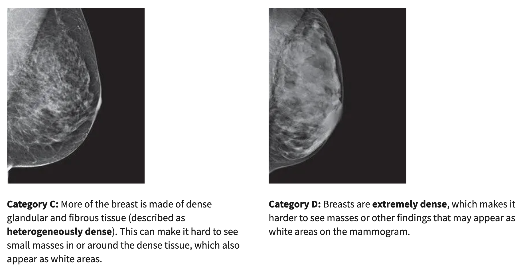 Photo of Breast Density Categories C & D