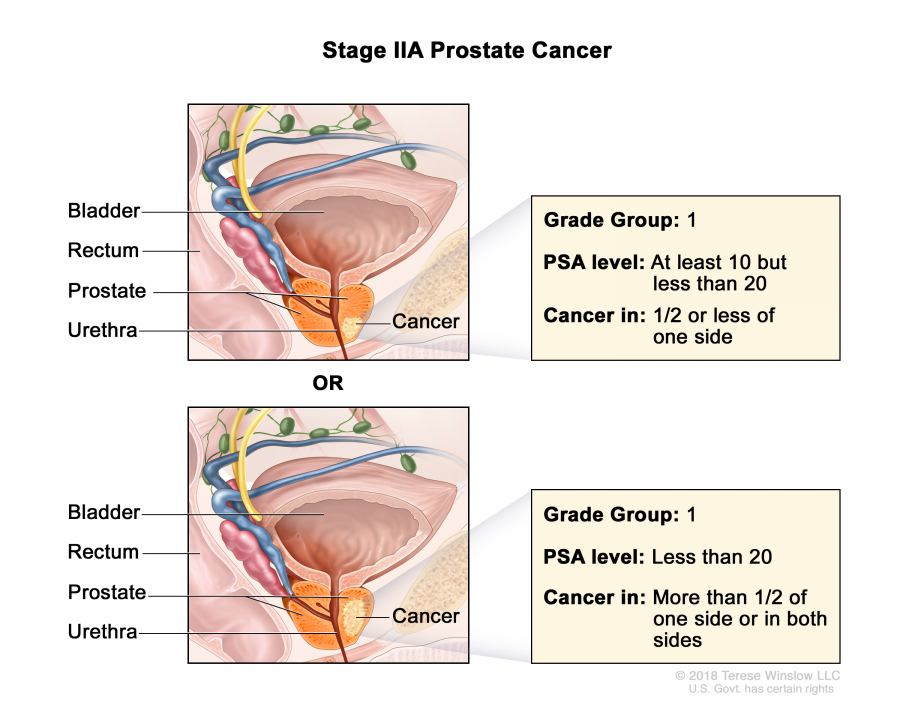 prostate-stage-2A_900_720.jpeg