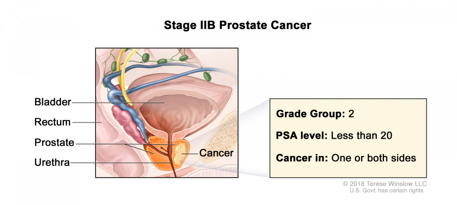 prostate-stage-2B_900_405.jpeg