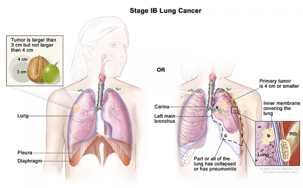lung-carcinoma-stage1B_600_372.jpeg