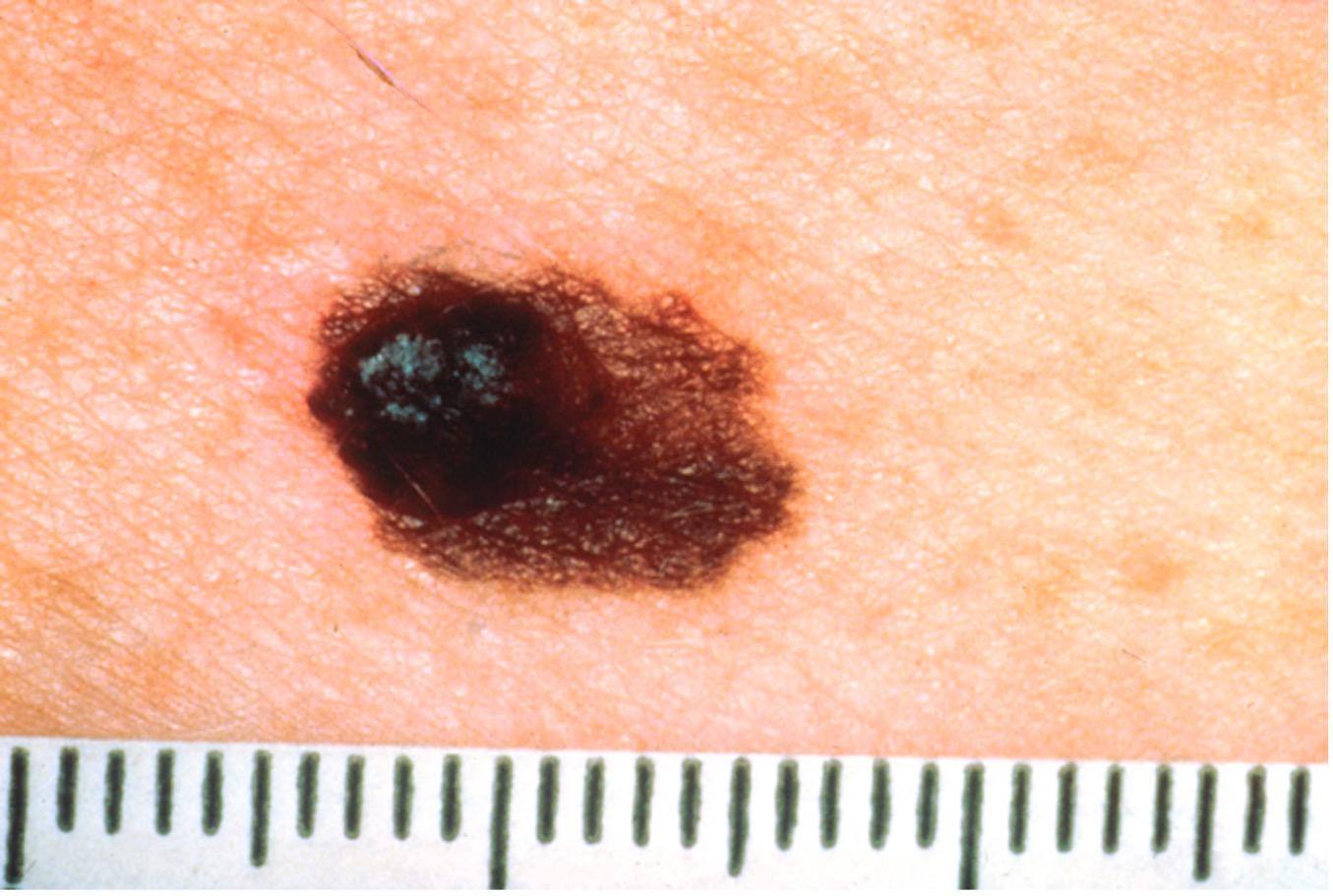 How to Detect Skin Cancer - Minnesota Oncology