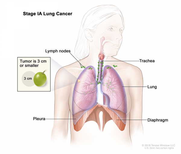 lung-carcinoma-stage1A_600_510.jpeg