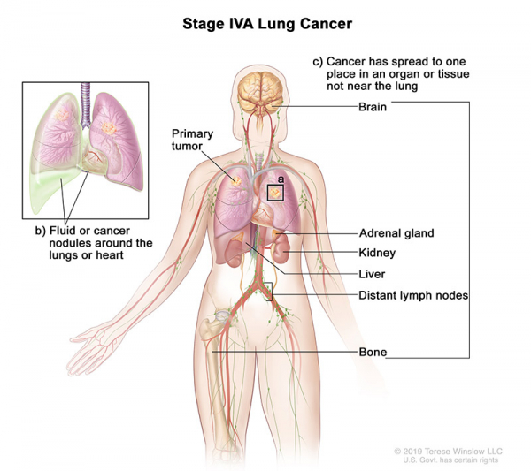 lung-carcinoma-stage4A_600_533.jpeg