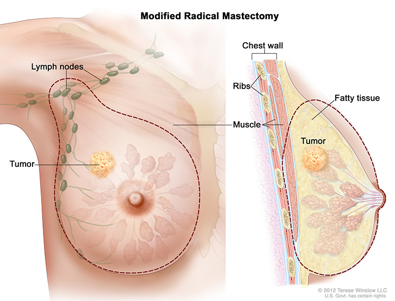 breast-mod-radical-mastectomy.jpeg