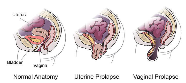 Pelvic Floor Prolapse Surgery Recovery Review Home Co 4812