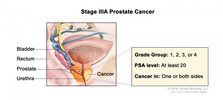 prostate-stage-3A_900_405.jpeg