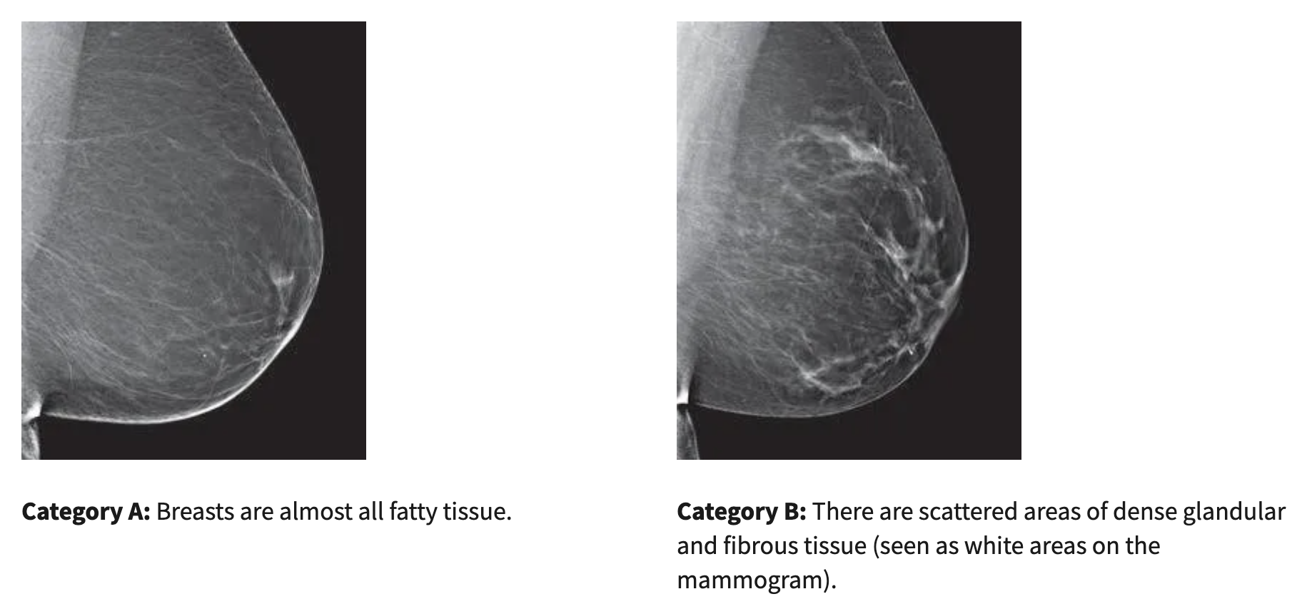 Photo of Breast Density Categories A & B