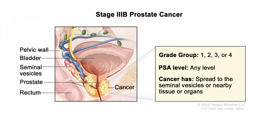 prostate-stage-3B_900_405.jpeg