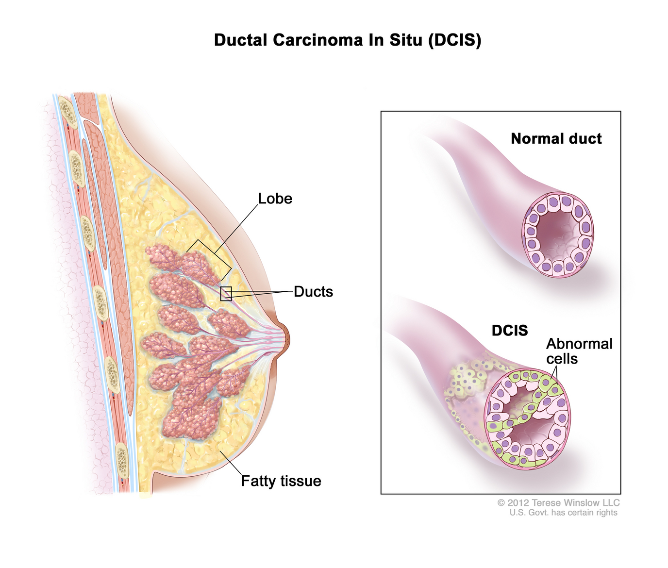 Breast Cancer and its types 