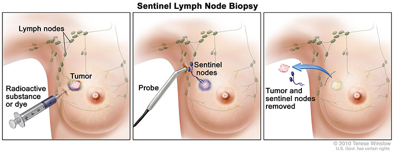 breast-sentinel-node-abc-title.jpeg