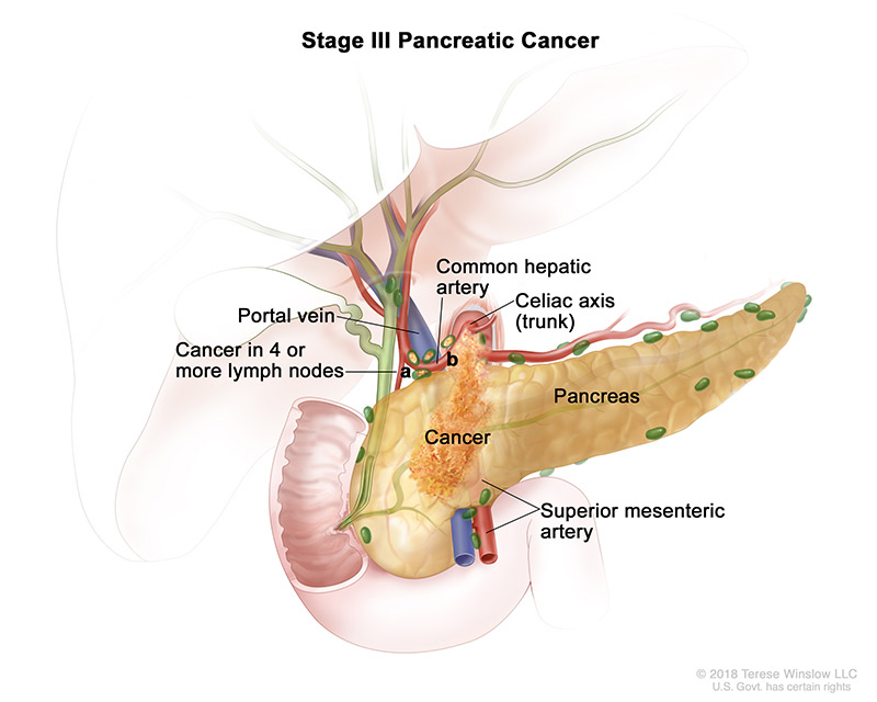 pancreatic-ca-stage-3.jpeg