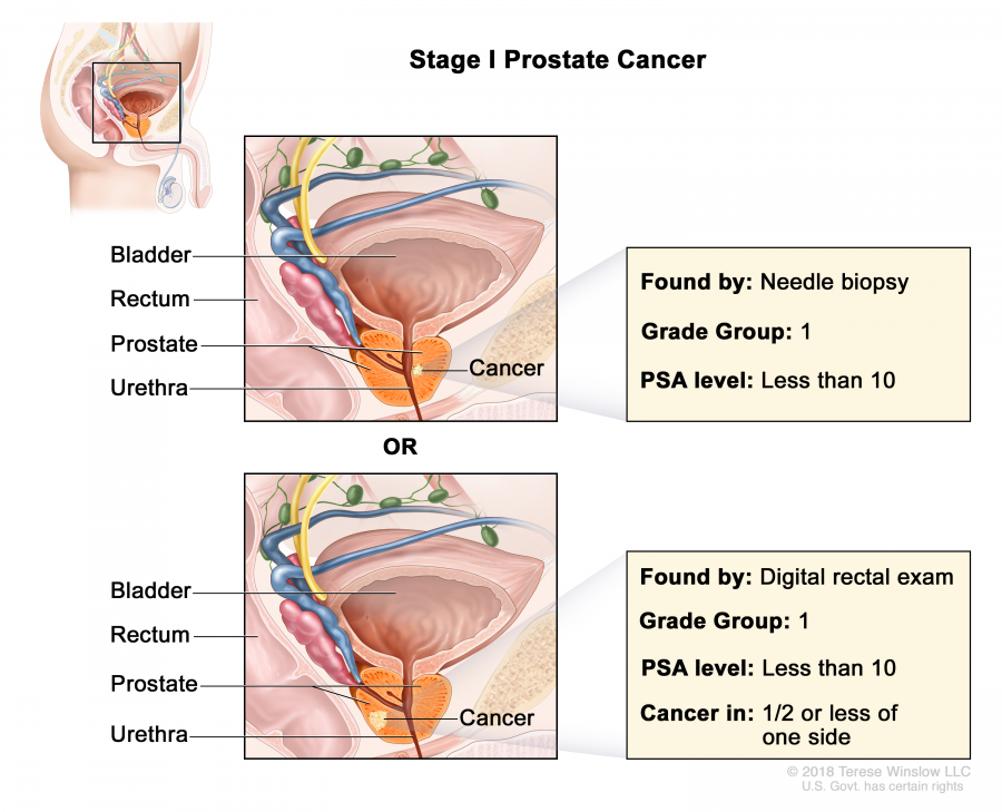 prostate-stage-1_900_729.jpeg