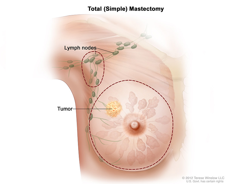 breast-total-simple-mastectomy_1.jpeg
