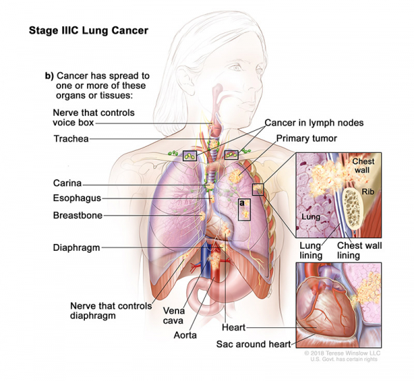 lung-carcinoma-stage3C_600_553.jpeg
