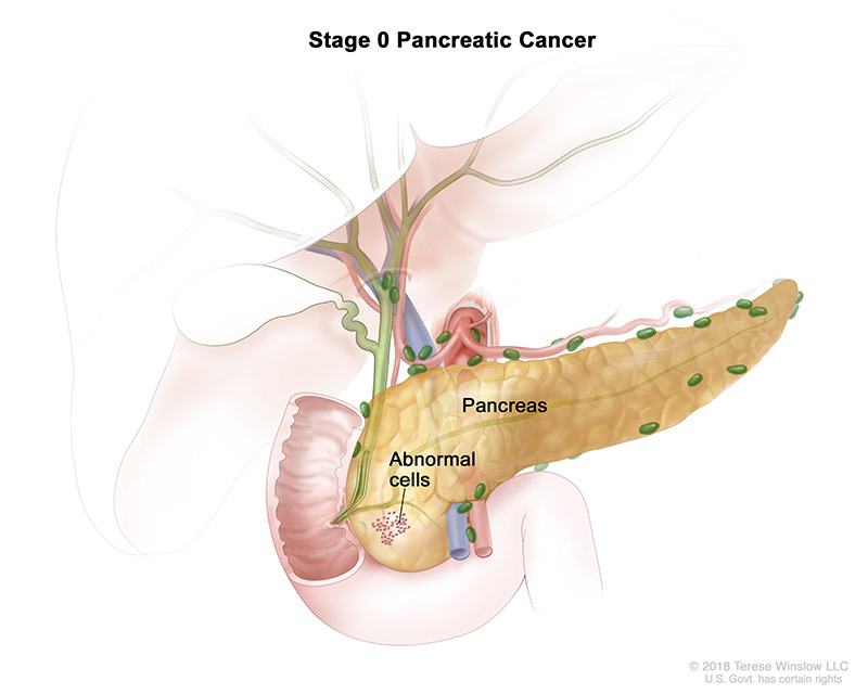 pancreatic-ca-stage-0.jpeg