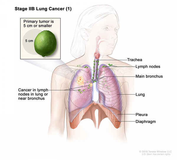 lung-carcinoma-stage2BPart1_600_540.jpeg