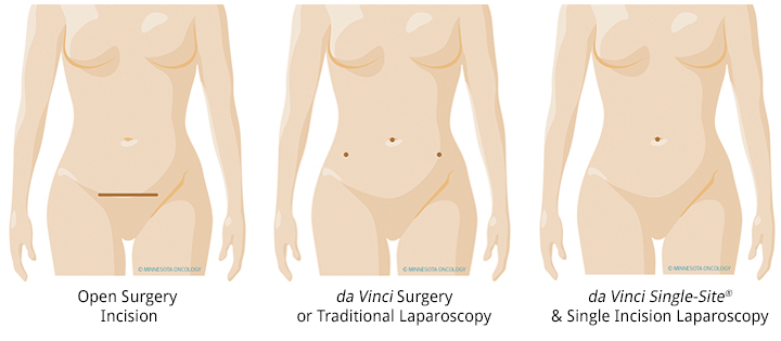 Laparoscopic oophorectomy - Mayo Clinic