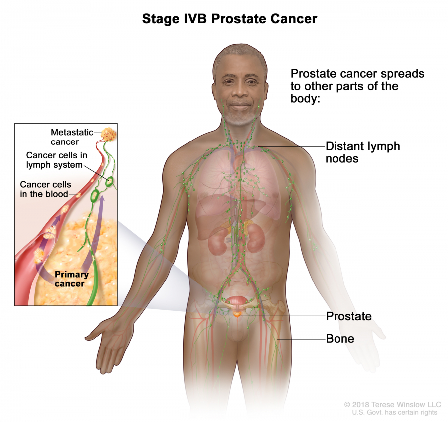 prostate-stage-4B_900_847.jpeg