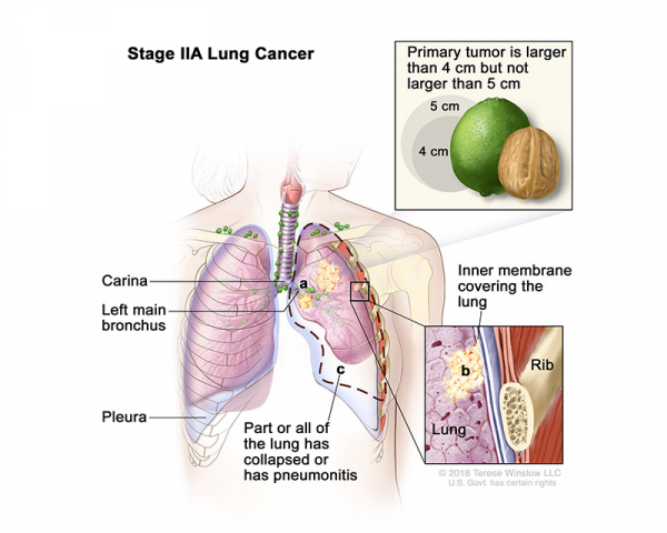 lung-carcinoma-stage2A_600_480.jpeg