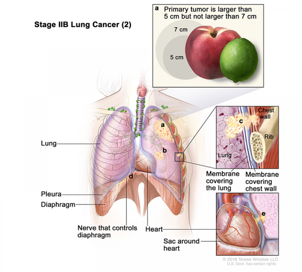lung-carcinoma-stage2BPart2_600_540.jpeg
