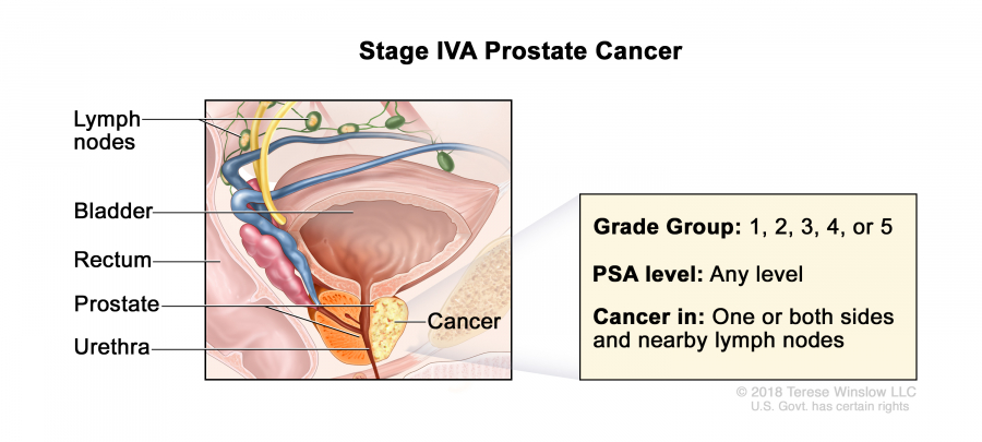 prostate-stage-4A_900_405.jpeg