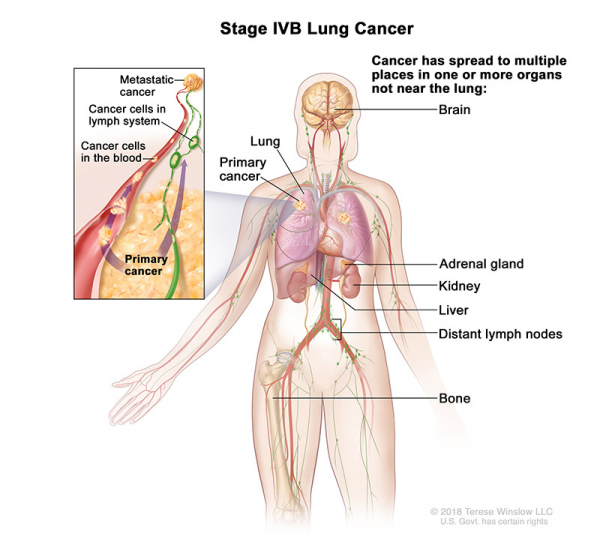 lung-carcinoma-stage4b_600_533.jpeg