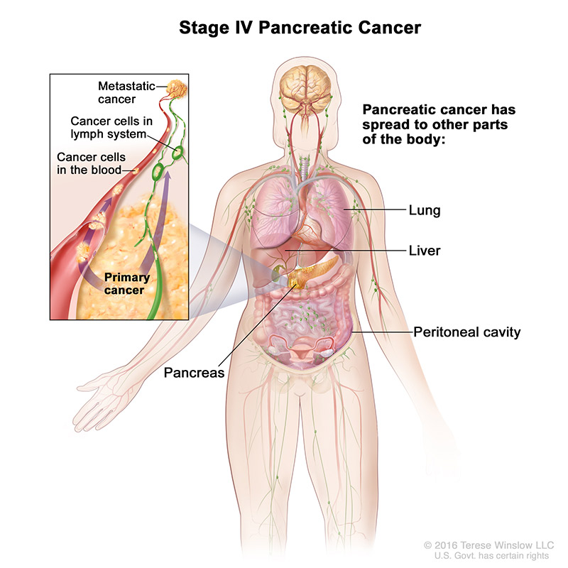 pancreatic-ca-stage-4.jpeg