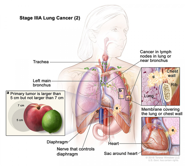 lung-carcinoma-stage3APart2_600_540.jpeg