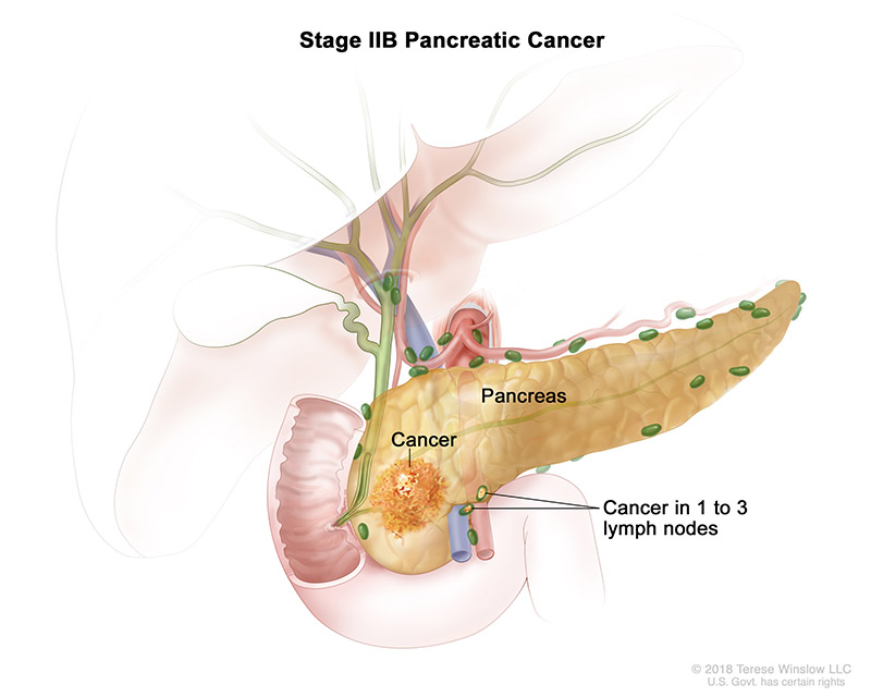 pancreatic-ca-stage-2B.jpeg