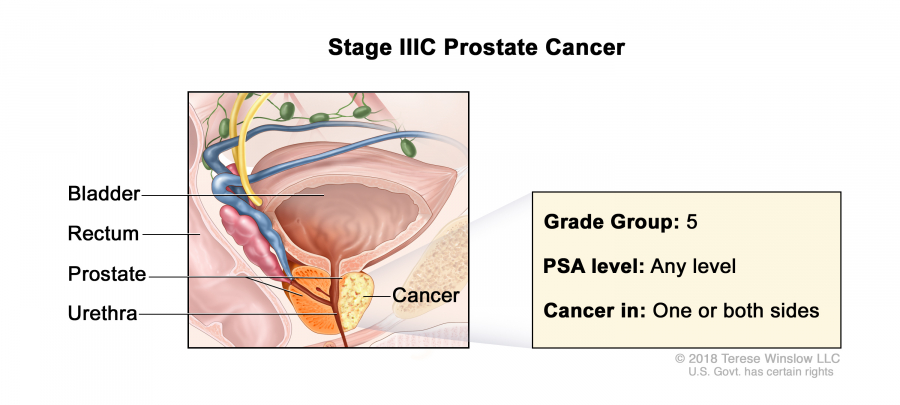prostate-stage-3C_900_405.jpeg
