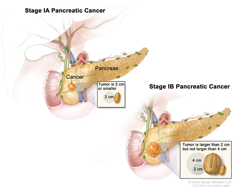 pancreatic-ca-stage-1A1B.jpeg