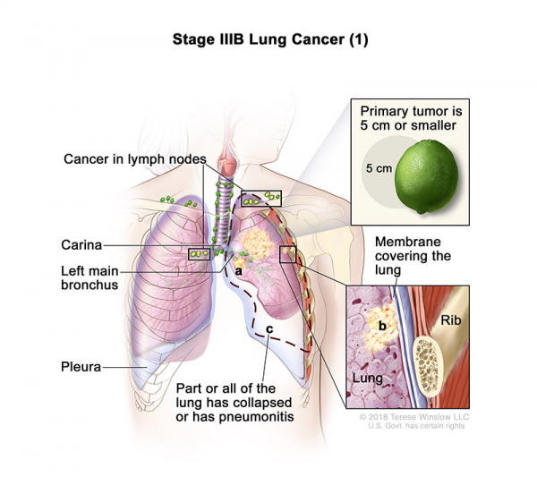 lung-carcinoma-stage3BPart1_600_533.jpeg